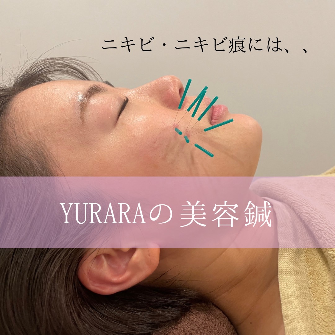 ニキビ肌にはYURARAの美容鍼💖